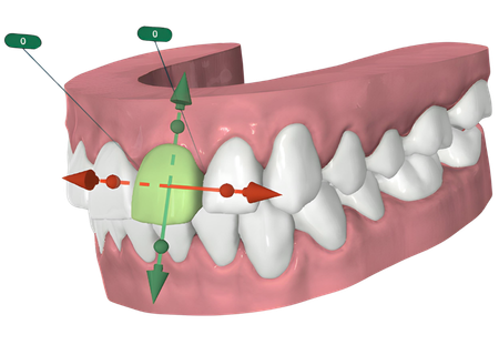 Dental aligner tray