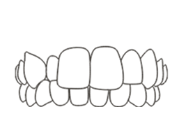 Crossbite