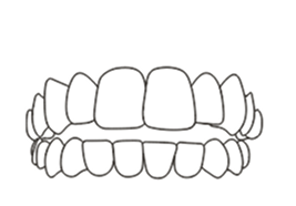 Open Bite