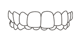Overbite